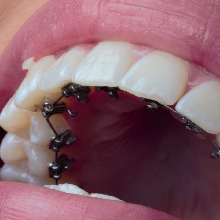 Ortodoncia lingual (1)
